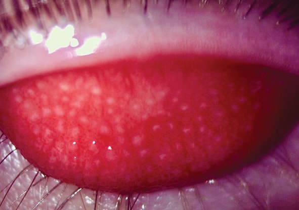 Giant Papillary Conjunctivitis Diagnostic Pearls Modern