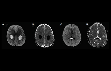Recurrent Stroke Like Events Before Diagnosis Of X Linked Charcot Marie Tooth Disease Practical Neurology Recurrent Stroke Like Events Before Diagnosis Of X Linked Charcot Marie Tooth Disease Practical Neurology