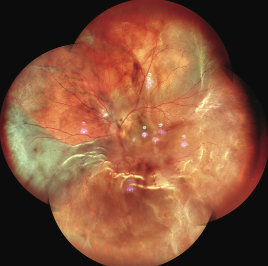 SLO-Based Widefield Imaging: An Atlas of Retinal Detachments - Retina Today