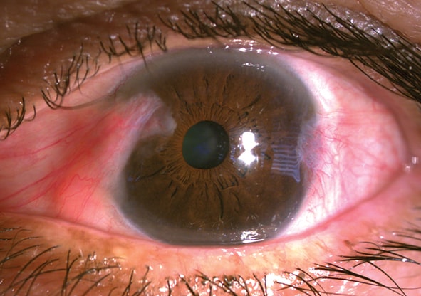 Pterygium - Modern Optometry