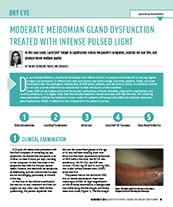 Moderate Meibomian Gland Dysfunction Treated With Intense Pulsed Light image