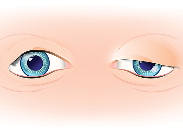 Ocular Ptosis and Its Differential Diagnosis - Modern Optometry