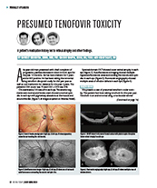 Presumed Tenofovir Toxicity