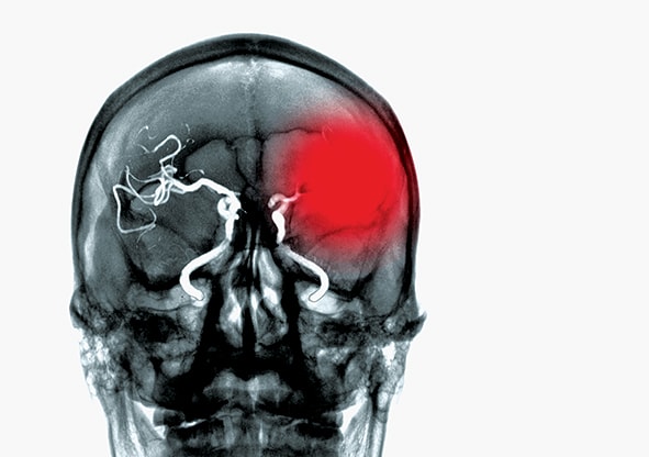 retinal-artery-occlusion-a-sign-of-stroke-modern-optometry