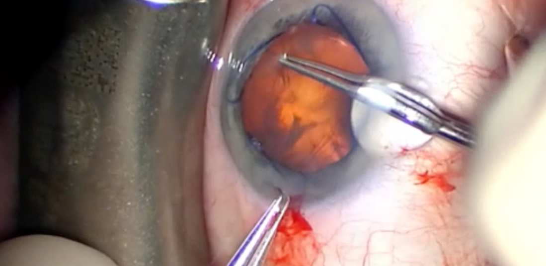 Malyugin Ring MST-Easy Insertion and Removal Tips J.T.Kavanagh MD Eye  Associates of South Texas HD - YouTube