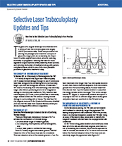 Selective Laser Trabeculoplasty