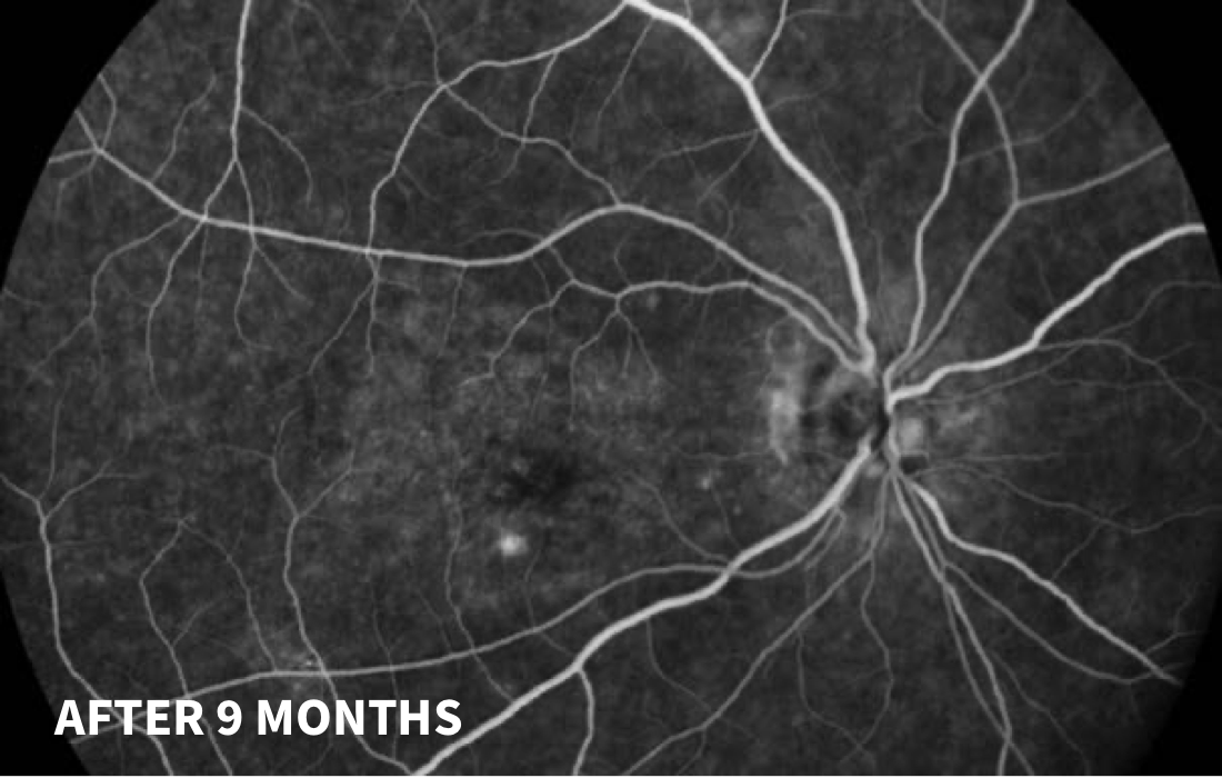 chronic-posterior-uveitis-irvine-gass-syndrome-od-retina-today