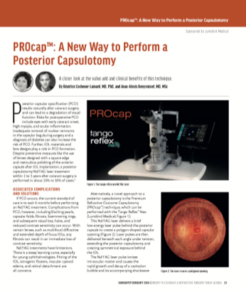 PROcap™: A New Way to Perform a Posterior Capsulotomy image
