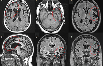 Frontotemporal Dementias Practical Neurology