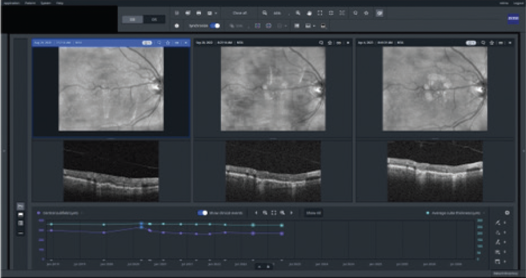 Case NO. 1 Image Registration and Tracking with the ZEISS Retina