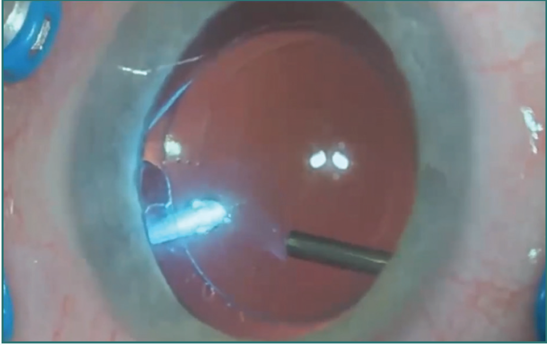 Vitreous Opacities Retina Today