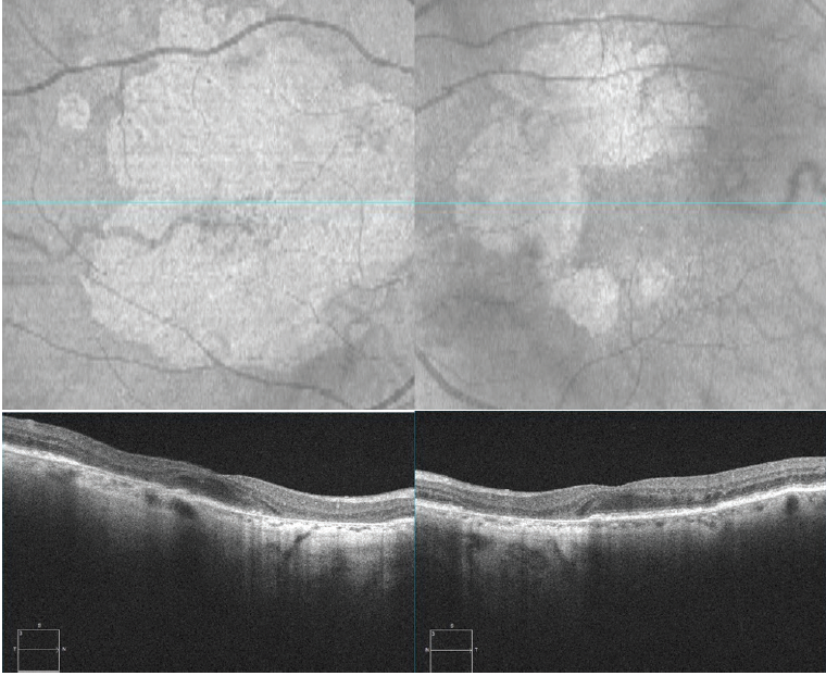 Case NO.2 Tracking Lesion Growth with the ZEISS Retina Workplace