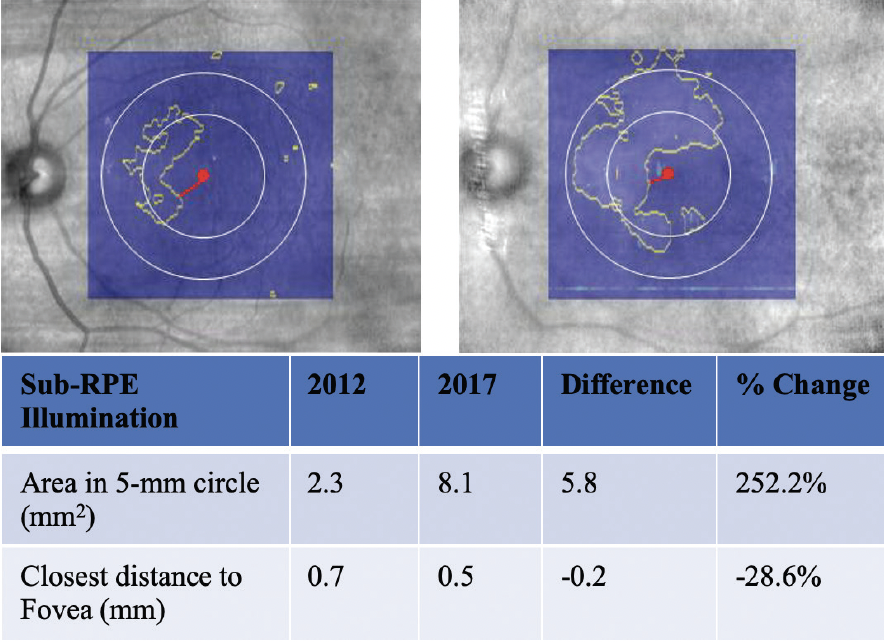 Case NO.2 Tracking Lesion Growth with the ZEISS Retina Workplace
