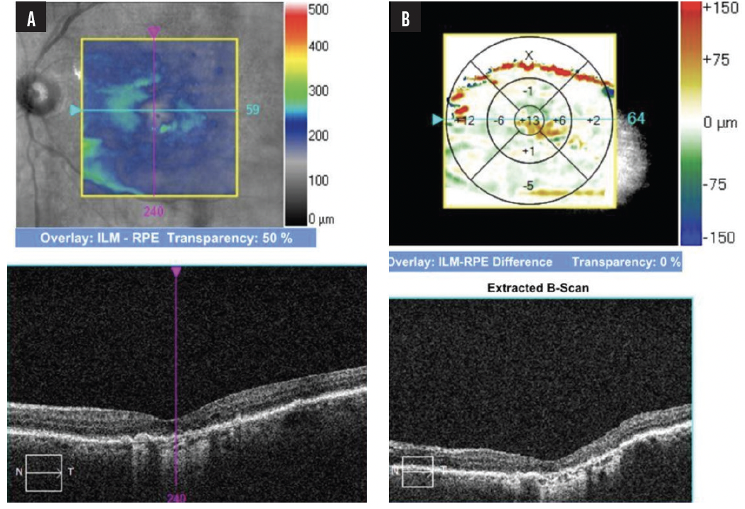 Case NO.3 GA in a Monocular Patient Retina Today