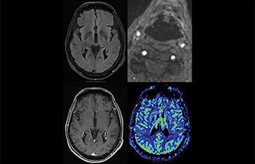 Alzheimer's & Dementia - Practical Neurology