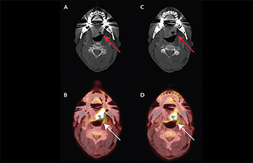 Glossopharyngeal Neuralgia Practical Neurology