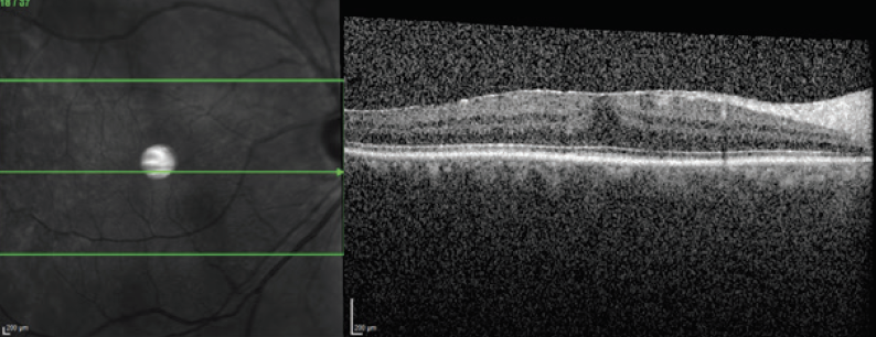 Vitreous Opacities - Retina Today