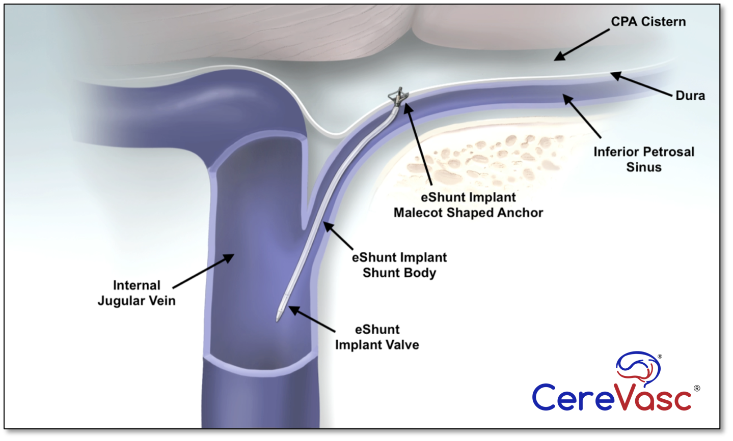 CereVasc and LianMedical Partner to Bring eShunt System to Asian Markets -  Endovascular Today