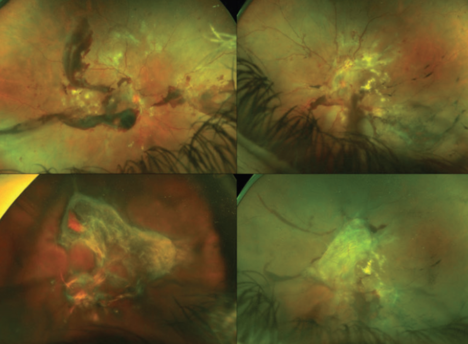 Pars Plana Vitrectomy Versus Medical Treatment For Proliferative ...