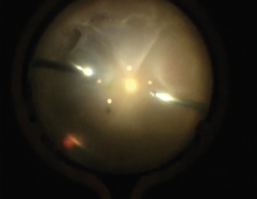 Vitrectomy Retinal Detachment