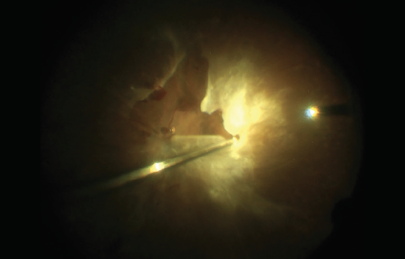 Viscodissection In Severe Diabetic Tractional Retinal Detachments