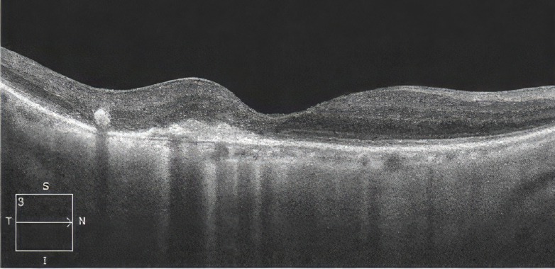 Management of Predominantly Classic Choroidal Neovascularization Due to ...