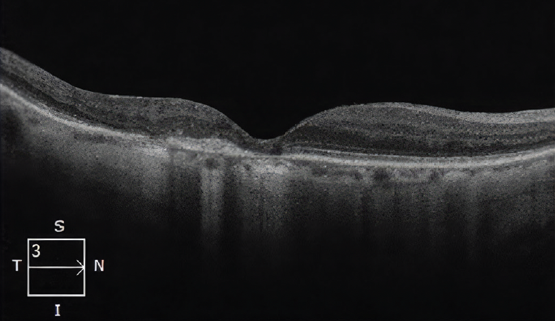 Management Of Predominantly Classic Choroidal Neovascularization Due To 