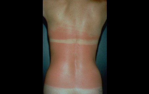 AAD: Sixty Percent of Americans Have Gotten Sunburned So Badly Their Clothes Were Uncomfortable image