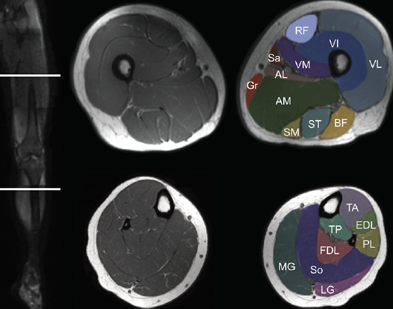 Muscle MRI for Neuromuscular Disorders - Practical Neurology