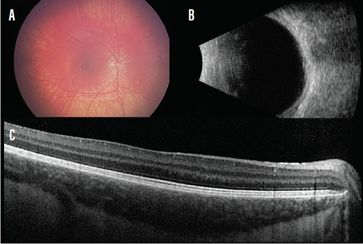 Fovea