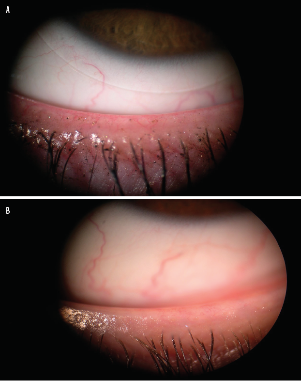 Enhance Your Dry Eye Practice With IPL - Modern Optometry