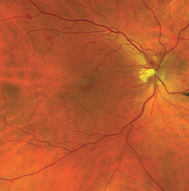 dot blot hemorrhages