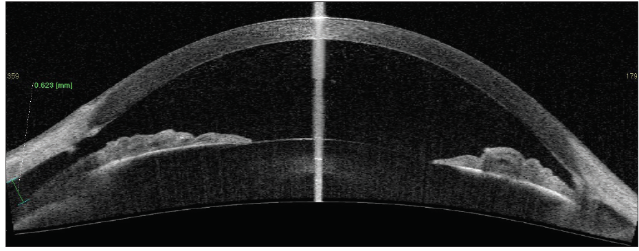 <p>Figure 2. On postoperative day 4, AS-OCT revealed a nasal cyclodialysis cleft spanning 39º of arc with adjacent ciliochoroidal effusions that had a maximum height of 623 µm.<br />
Courtesy of Thomas A. Berk, MD, and Hady Saheb, MD, MPH, FRCSC</p>