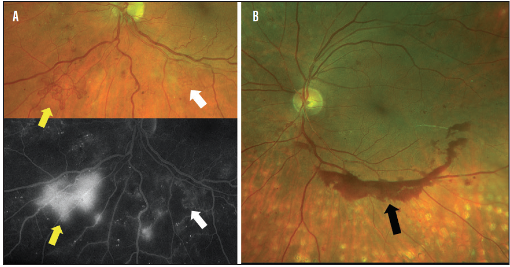 The Usual Retina Suspects Modern Optometry