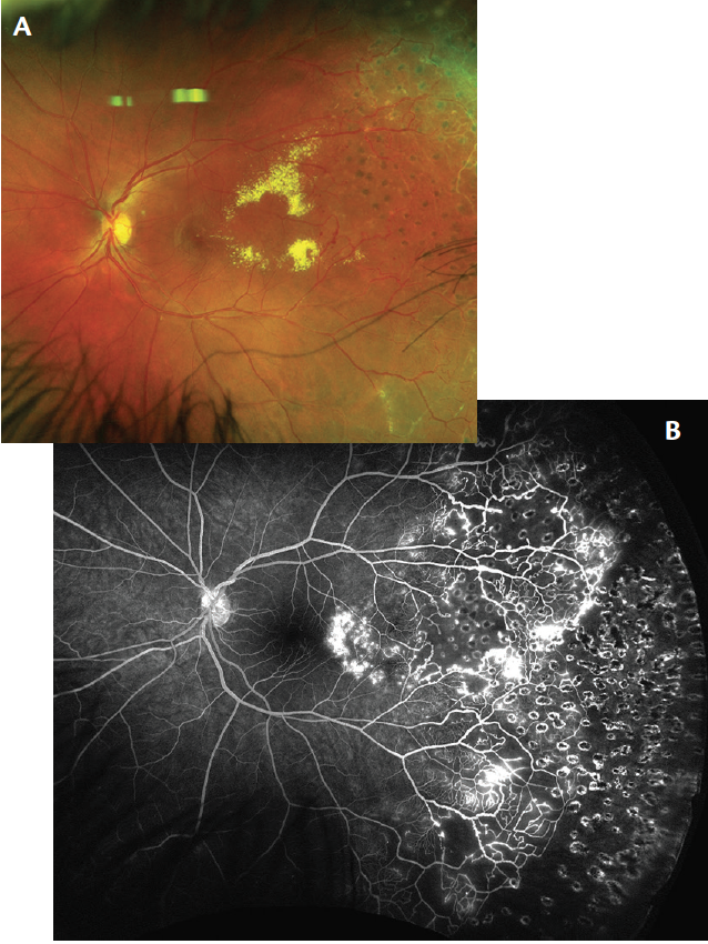 Ultra-Widefield Imaging Guides Coats Disease Treatment - Retina Today