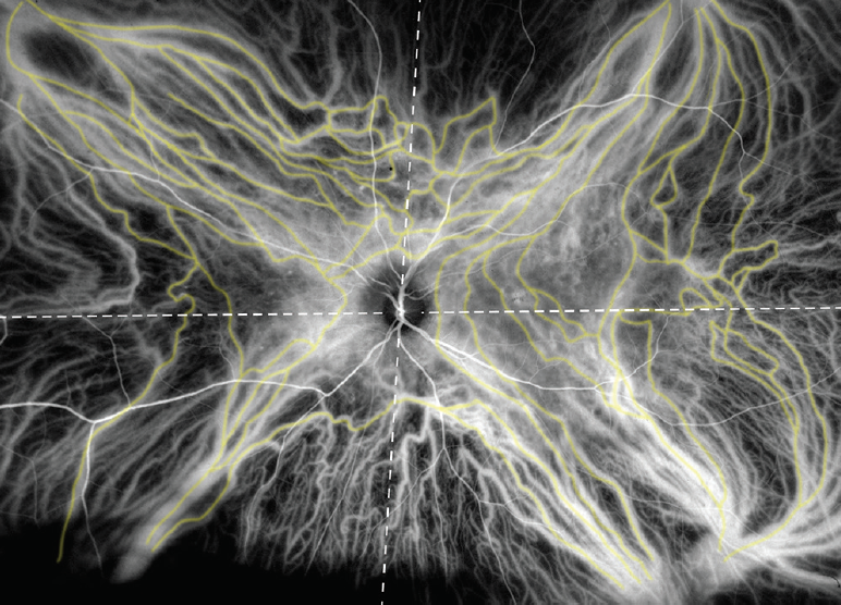 an icg angiogram of a patient with csc