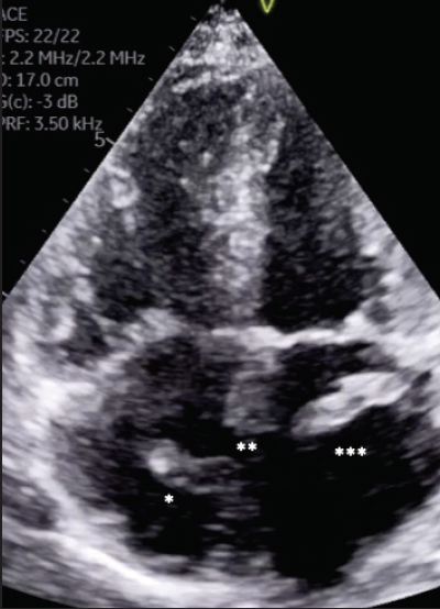 The Right Device in Right Heart: AngioVac System for Clot in Transit ...