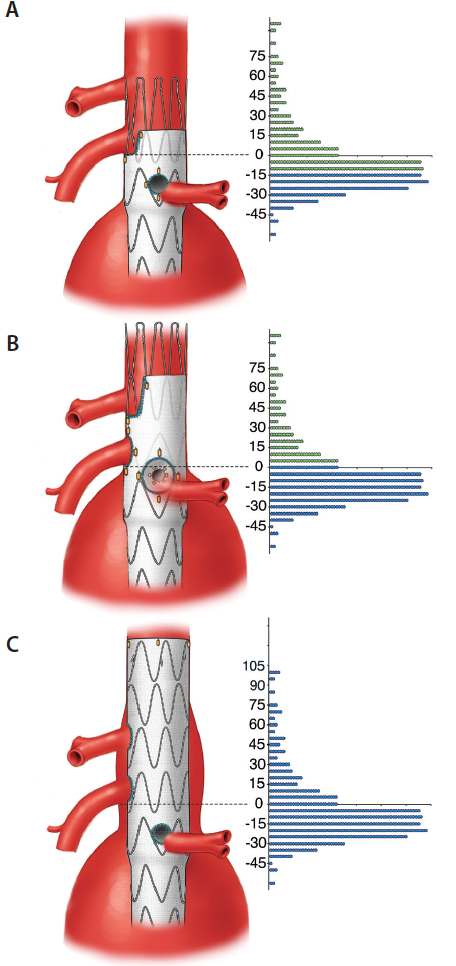 Modern Complex Stent Graft Designs: A Closer Look - Endovascular Today