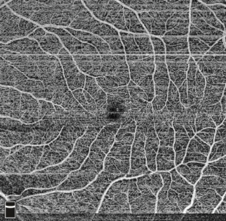 OCTA: Pearls And Pitfalls - Retina Today