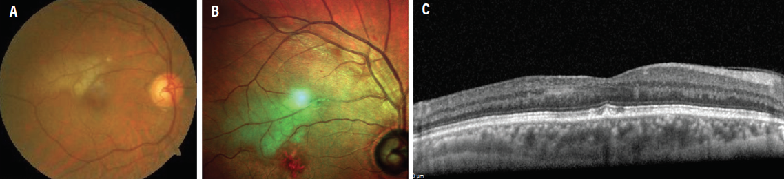 The Benefits of Identifying Paracentral Acute Middle Maculopathy ...