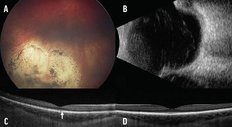 Transradial IntraArterial Chemotherapy for Retinoblastoma - Retina Today