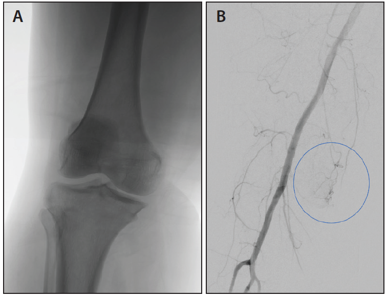 Genicular Artery Embolization Knee 