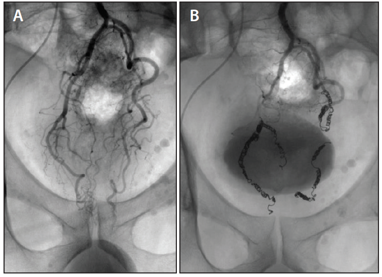 Emborrhoid Technique for Chronic Hemorrhoidal Disease Where Do We Stand? Endovascular Today