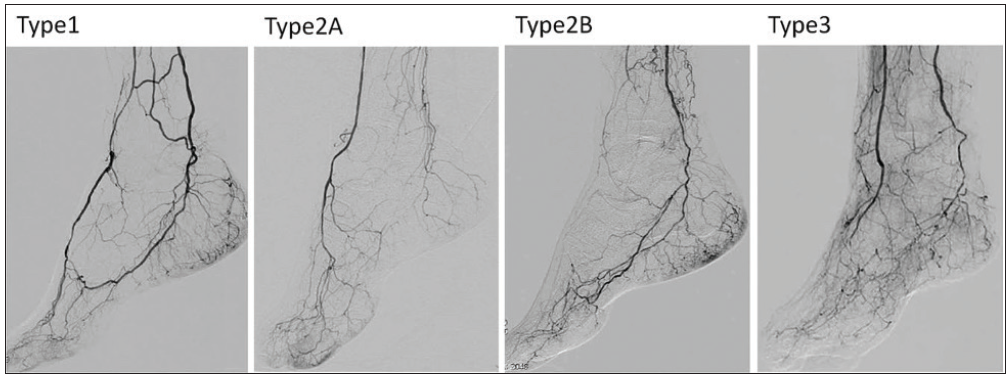 Pedal Artery Revascularization Where Are We In 2021 Endovascular Today