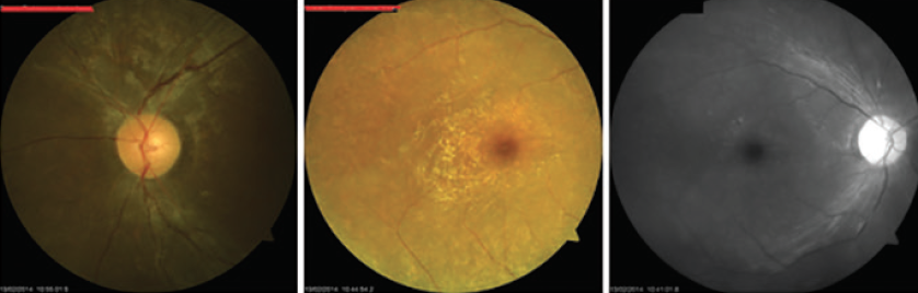 Classical Presentation, Unlikely Geographical Location - Retina Today