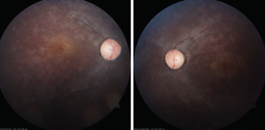 Classical Presentation, Unlikely Geographical Location - Retina Today