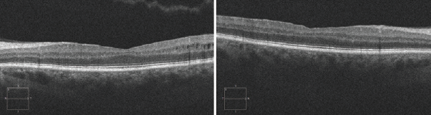 A Rare Manifestation of Chronic Myelogenous Leukemia - Retina Today