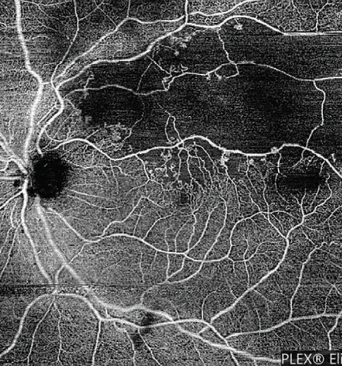 빛간섭단층혈관조영술(Optical Coherence Tomography Angiography, OCTA) : 네이버 블로그