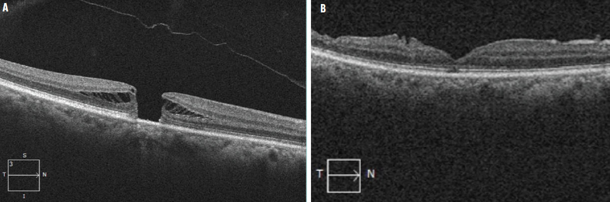 Three Ways to Tackle Tough Macular Holes - Retina Today