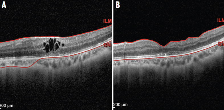 Epiretinal Membrane Grading